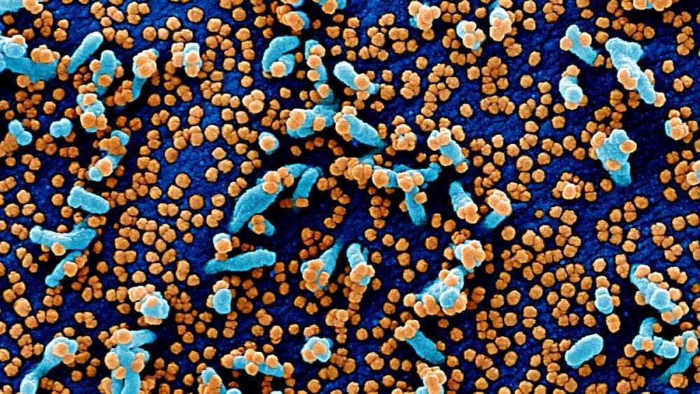 Colorized scanning electron micrograph of a VERO E6 cell heavily infected with SARS-COV-2 virus particles, isolated from a patient sample.