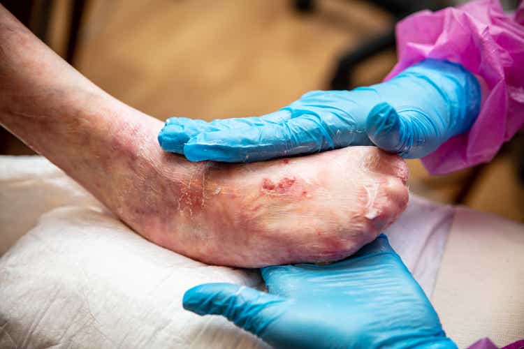 Epidermolysis bullosa, nurse put on some lotion on the foot