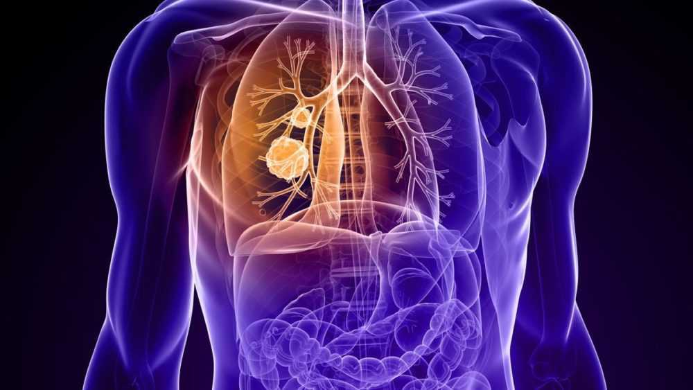 Illustration of lung cancer
