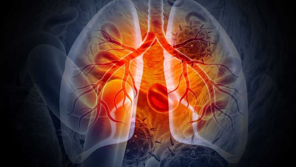 A medical Illustration showing lung cancer or bronchial carcinoma.