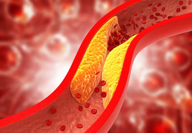 Verstopte slagaders, De plaque van de cholesterol in slagader
