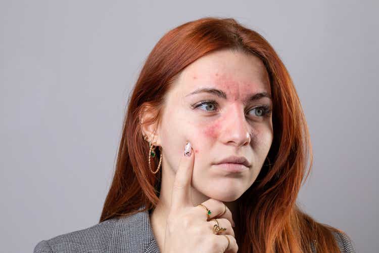 Молодая женщина со светлой кожей, страдающая розацеа.  Покраснение лица из-за купероза